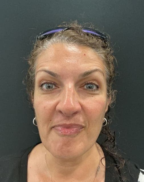 Neuromodulators result, after treatment