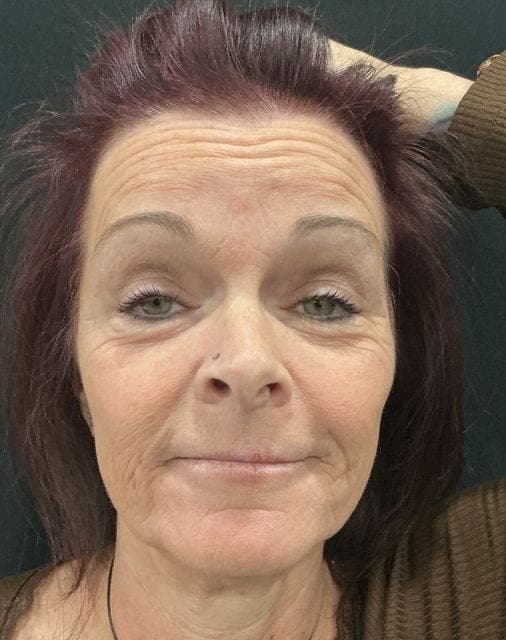 Neuromodulators result, before treatment