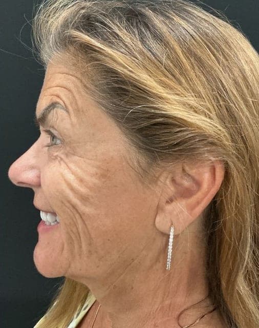 Neuromodulators result, after treatment